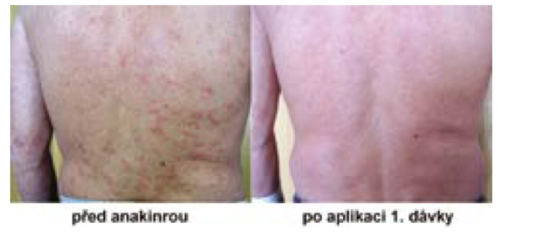 Pacient před a po užívání anakinry