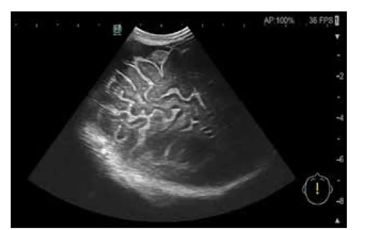 Hyperechogénne sulci ako príznak meningitídy v USG
obraze (archív Neonatologickej klinike JLF UK a UNM)