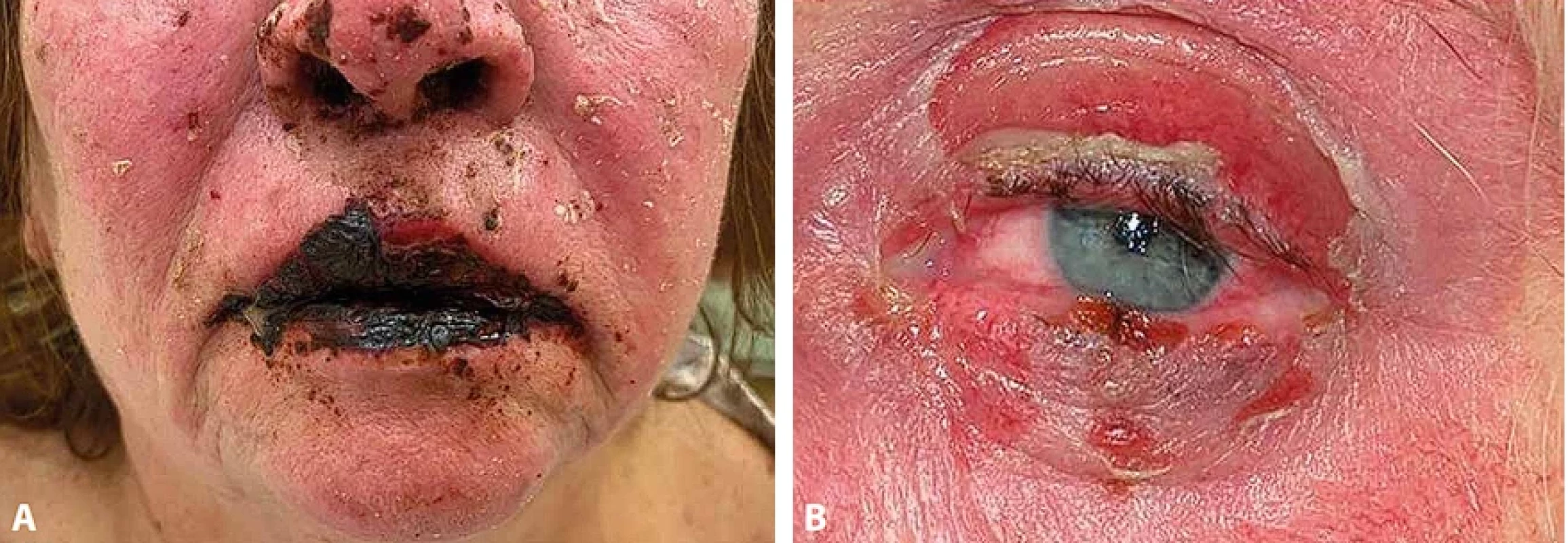Toxická epidermální nekrolýza, slizniční léze – klinický obraz. A. Postižení dutiny ústní. B. Postižení spojivky.