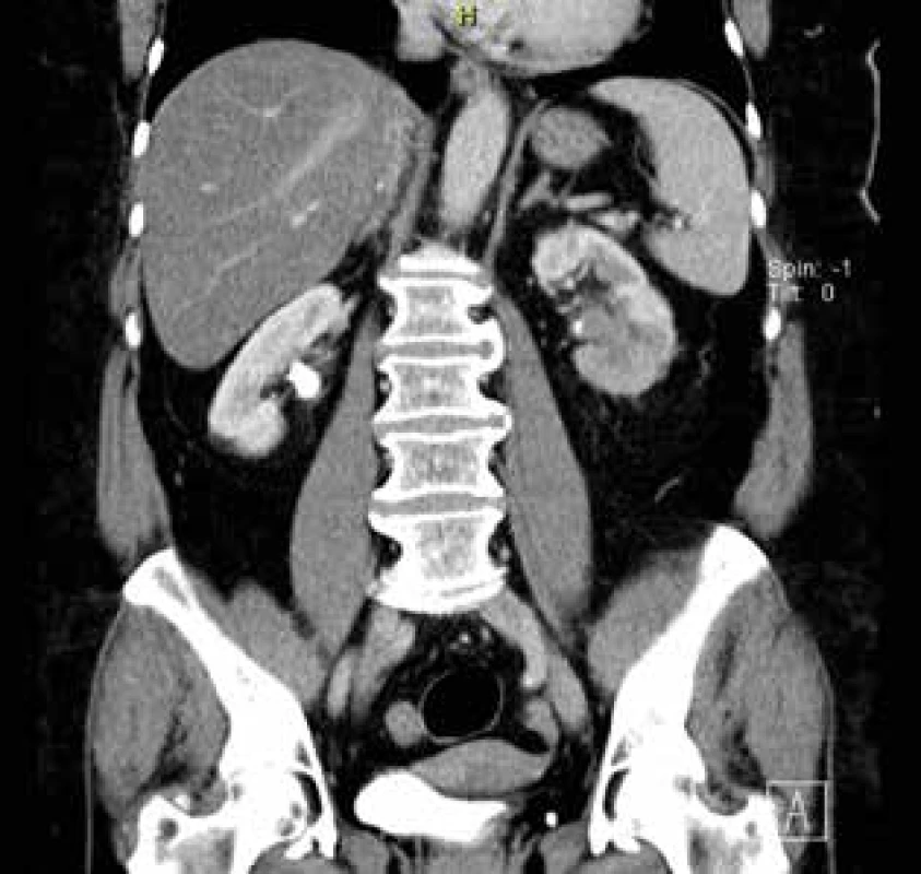 Uroteliální karcinom pánvičky levé ledviny – CT<br>
Fig. 2: Urothelial carcinoma of the renal pelvis of the left
kidney − Computed Tomography (CT)