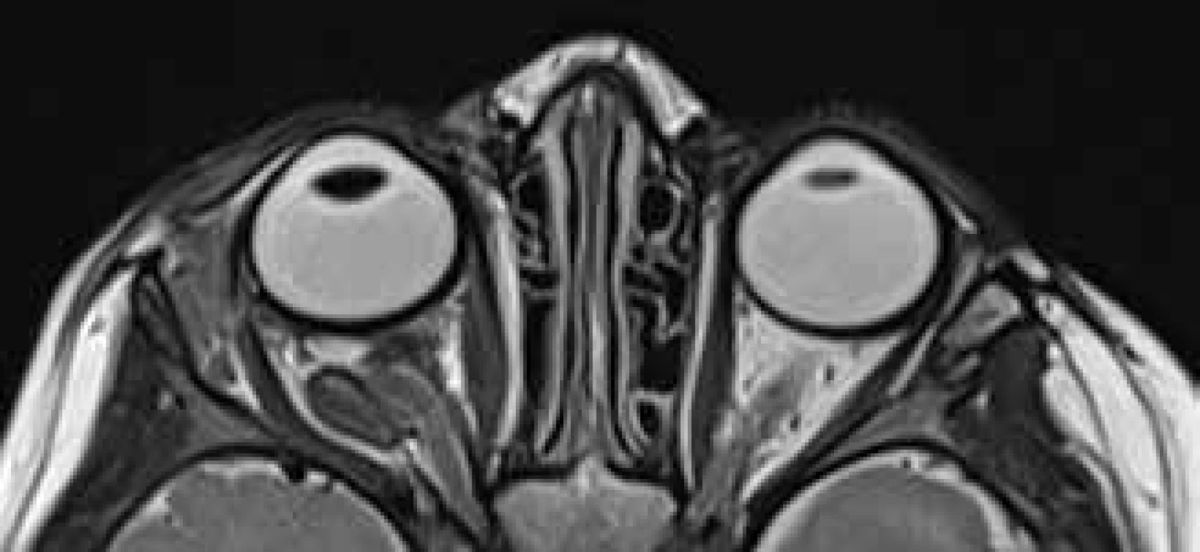 MRI vyšetření 6 týdnů po operaci. Přetrvávající
rozšíření pravé orbity, bulbus již bez protruze, optický
nerv esovitě vinutý