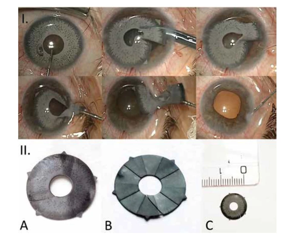 Explantace arteficiální kosmetické duhovky pravého oka (I.) a obrázek arteficiálního
kosmetického duhovkového implantátu po explantaci (II.): přední strana (A), zadní strana (B) a velikost
implantátu (C)