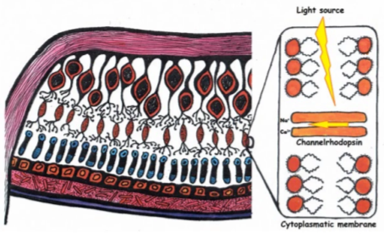 Optogenetics targteted at retinal cells. Incorporation of photosensitive receptor, in this case channelrhodopsin, into the cell membrane of a bipolar cell 