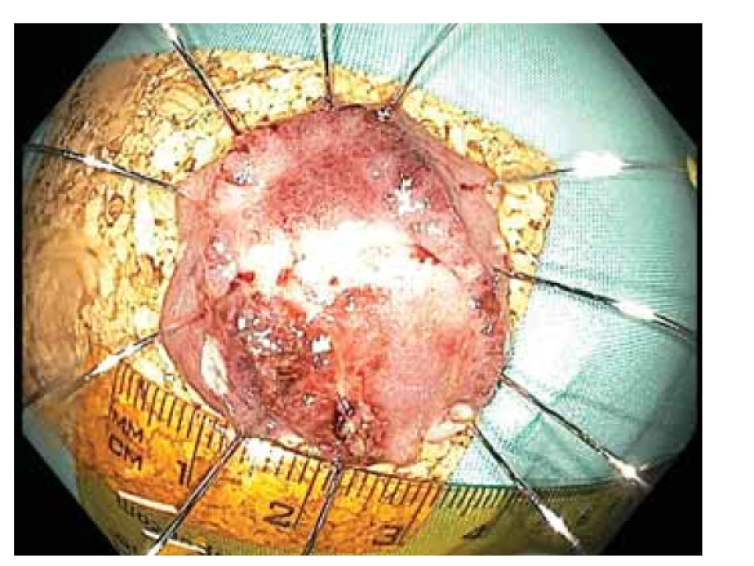 FTRD resekát léze z obr. 1, histologicky R0 resekce
dobře diferencovaného adenokarcinomu s povrchovou
submukózní invazí.<br>
Fig. 2. FTRD resection of the lesion of Fig. 1, histologically
R0 resection of well-differentiated adenocarcinoma with
superficial submucosal invasion.