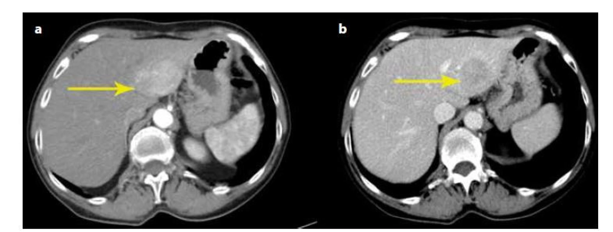 Výpočetní tomografie
1a − CT jater v arteriální fázi, hyperdenzní ložisko označeno šipkou; 1b − CT jater ve venózní fázi, hypodenzní ložisko označeno
šipkou.<br>
Fig. 1: Computed tomography
1a − Arterial phase, hyperdense lesion indicated by the arrow; 1b − Venous phase, hypodense lesion indicated by the arrow.