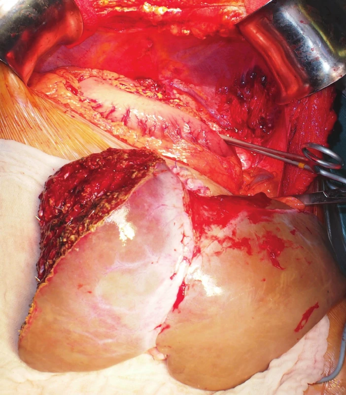 Obvious spatial discrepancy between the reduced
situs solitus graft and the situs inversus hepatic fossa
during the anhepatic phase