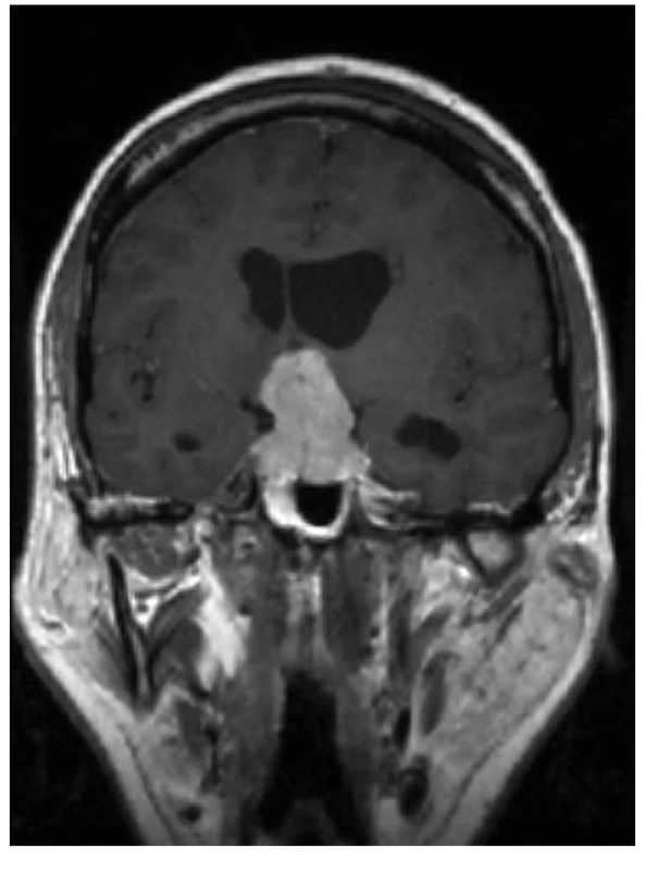 MR obraz makroadenomu hypofýzy (archiv autora
a Radiodiagnostické kliniky Všeobecné fakultní nemocnice a 1. LF UK v Praze)