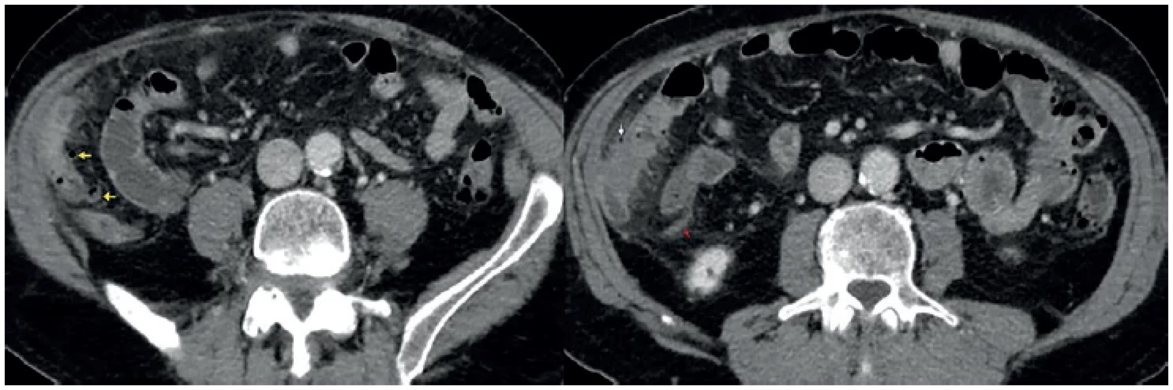 Divertikulitida ilea – CT břicha a pánve, po aplikaci jódové kontrastní látky, axiální sken <br> 
Fig. 2. Diverticulitis of the ileum – CT of the abdomen and pelvis, after administration of iodine contrast agent, axial scan