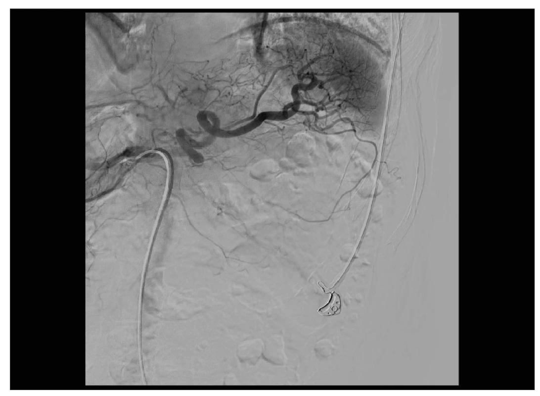 Selektivní angiografie truncus coeliacus, bez leaku KL v povodí a. lienalis