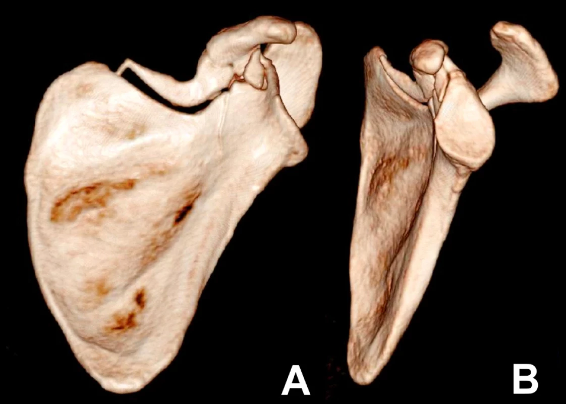 A+B – 3D CT reconstructions, anterior and lateral
views. The 3D CT reconstruction showed the fracture line
only partially, while it was well seen on 2D CT reconstructions
