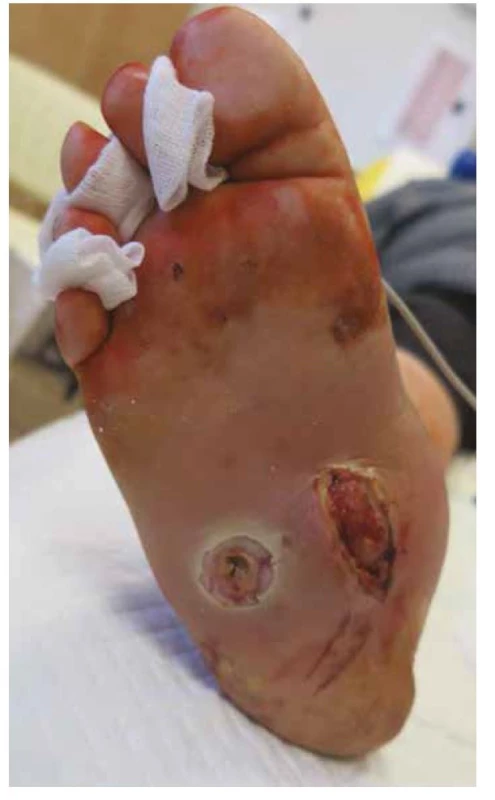 Typický syndrom diabetické nohy: kombinace Charcotovy osteoarthropatie,
deformit, ulcerací a infekce