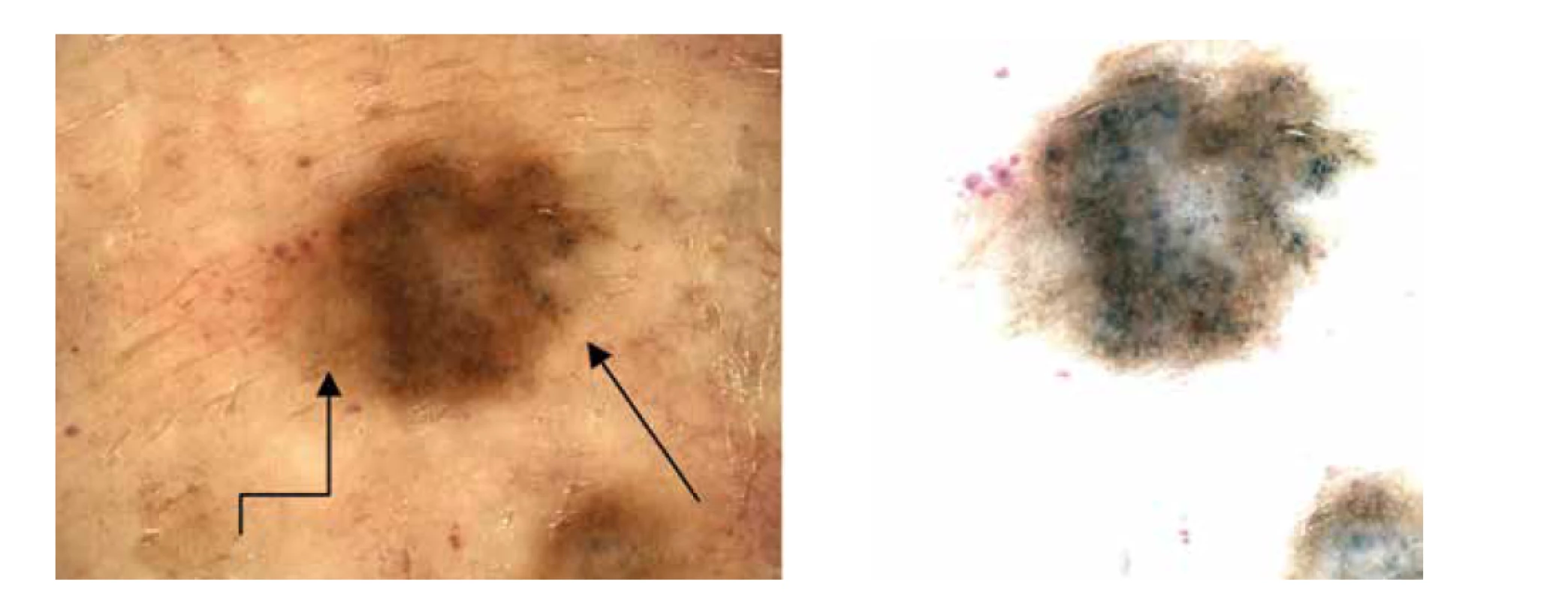 a,b. Dermatoskopicky heterogenní obraz – hnědé globule asymetricky, šedočerné tečky na pravém okraji (šipka),
diskrétní pigmentová síť na levém okraji (lomená šipka).