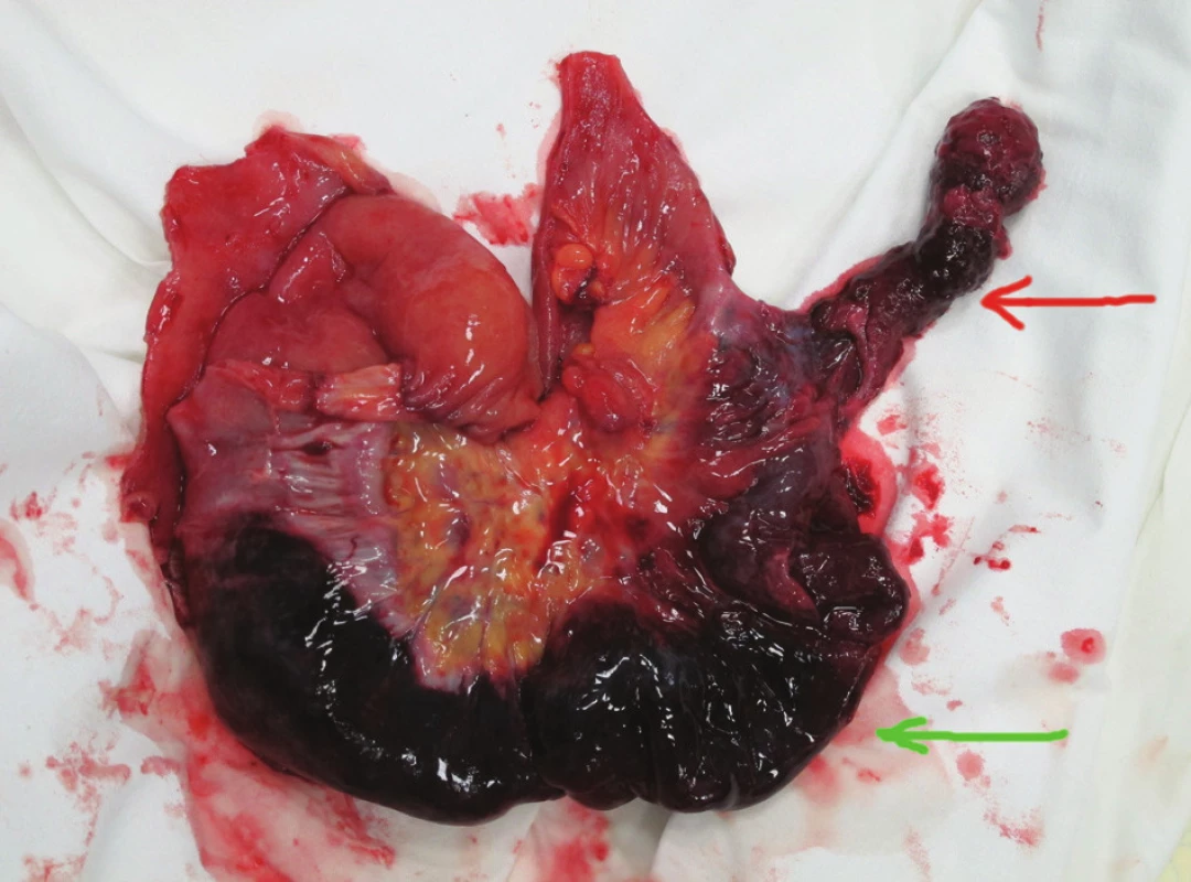 Specimen of the small intestine
Hemorrhagic infarcted invagination (green arrow) with inverted
Meckel’s diverticulum (red arrow).