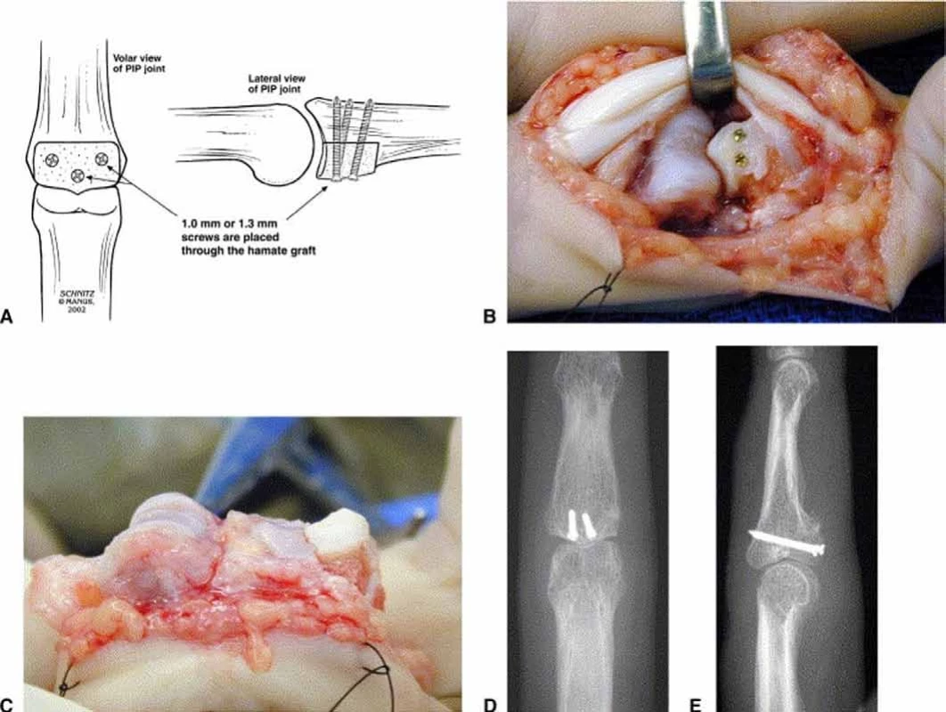 Schéma provedení hemi-hamátní artroplastiky [22]