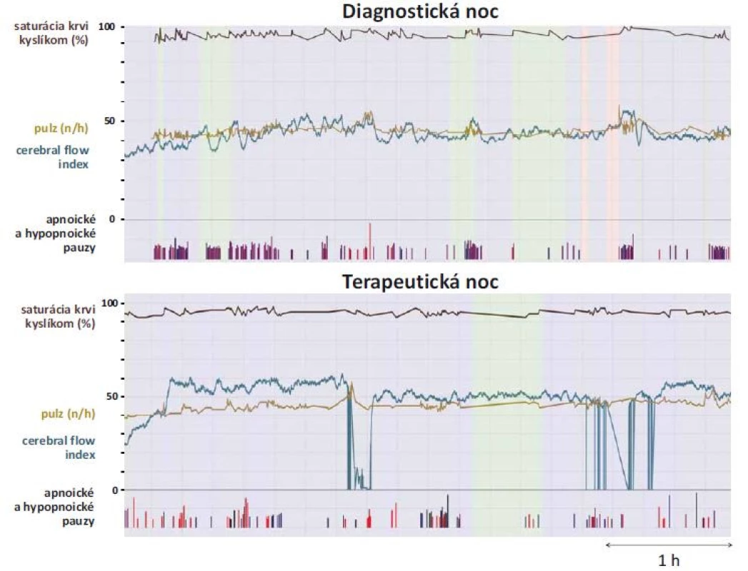 Grafické zobrazenie polysomnografických premenných synchronizovaných s indexom cerebrálneho prietoku krvi (cerebral
flow index) pomocou programu Biograph.<br>
Fig. 4. Polysomnographic variables synchronized with the cerebral flow index using Biograph software.