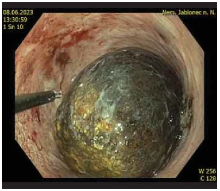 Endoskopická
revize
žlučníku cestou
cholecystoduodenostomie
–
objemný konkrement
a EHL
(elektrohydraulické)
vlákno. <br> 
Fig. 10. Endoscopic
revision of the gallbladder
via cholecystoduodenostomy
–
large stone and EHL
(electrohydraulic)
fi ber.