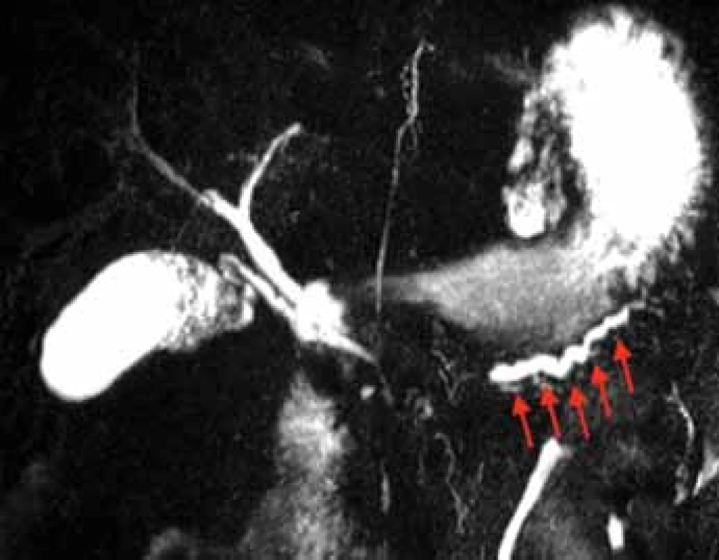 Pankreatogram za pomoci sMRCP u pacientky s DPDS, který byl diagnostikován 5,5 let po proběhlé ANP. Izolovaný pankreatický vývod označen šipkami. Použito se svolením M. L. Freemana, University of Minnesota, MN, USA.<br>
Fig. 6. A pancreatogram using sMRCP in a patient with DPDS
which was diagnosed 5.5 years following the index ANP. The isolated pancreatic duct is marked with arrows. Courtesy of ML Freeman, University of Minnesota, MN, USA.