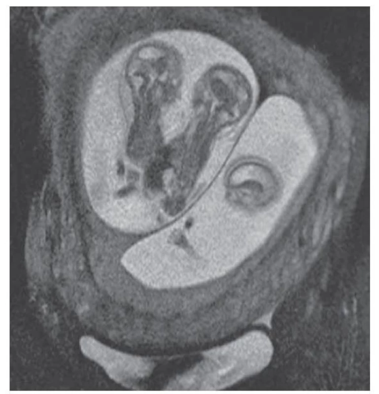Magnetická rezonance, trojčetná gravidita komplikovaná
přítomností srostlic, 14. týden těhotenství [13].<br>
Fig. 6. Magnetic resonance imaging, triple pregnancy complicated
by conjoined twins, 14th week of pregnancy [13].
