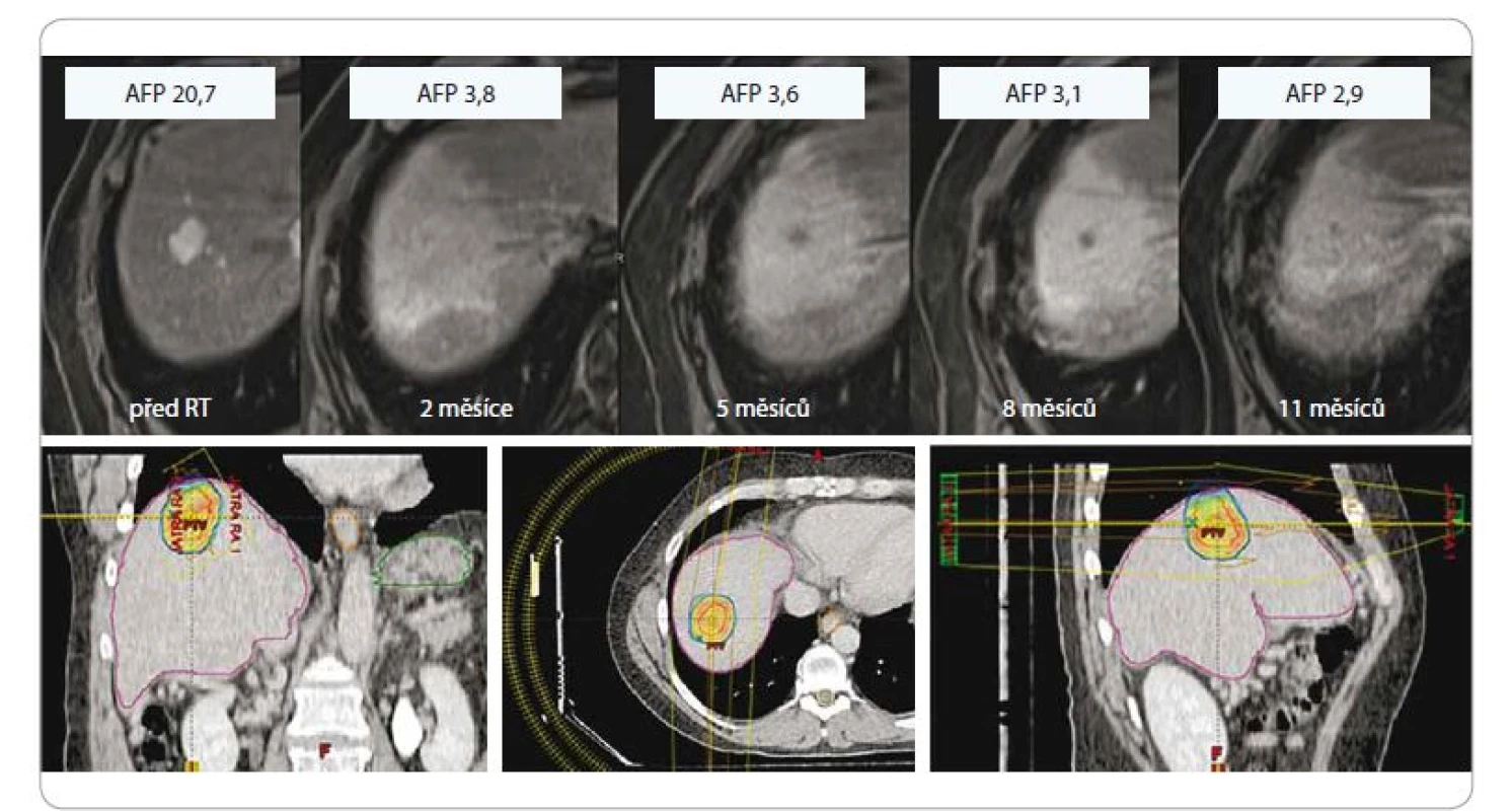 Hepatocelulární karcinom u 61letého pacienta po SBRT, dávka 3 × 18 Gy, předpis na 80% izodózu, efekt léčby (regrese,
pokles AFP, asymptomatická postradiační reakce v okolním jaterním parenchymu).<br>
SBRT – extrakraniální stereotaktická radioterapie, AFP – alpha-fetoprotein, Gy – Gray