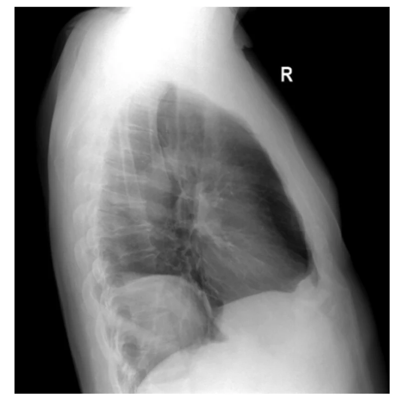 Kontrolní boční projekce; viditelné vyklenutí<br>
Fig. 2. Control radiograph