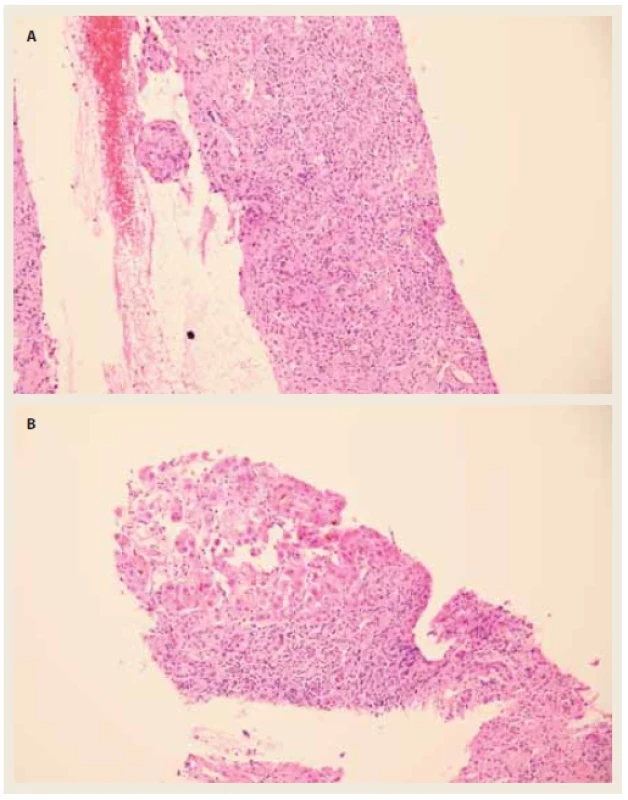 a, b) Transjugulární biopsie jater.  <br> 
Fig. 1. a, b) Transjugular liver biopsy.