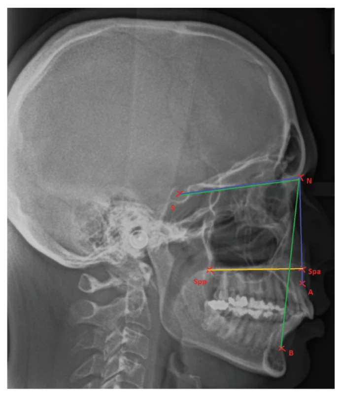 Position of jaws related to the cranial base and pointing out the maxillary corpus<br>
Point A: the most concave point of anterior maxilla;<br>
Point B: the most concave point on mandibular symphysis;<br>
N: nasion; S: the middle of sella turcica;<br>
Spp: the most posterior point on spina nasalis posterior;<br>
Spa: the most anterior point on spina nasalis anterior
