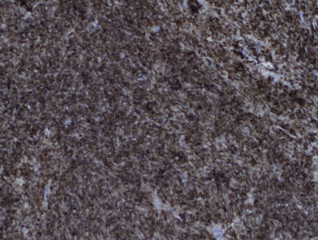 Imunohistochemické vyšetření CD1a, zvětšení 100krát