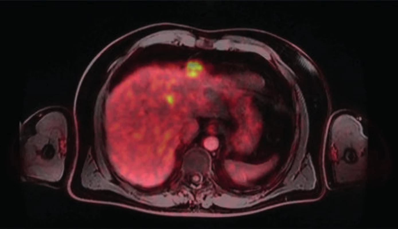 Vícečetné metastázy karcinomu rekta v játrech<br>
Fig. 1: Multiple liver metastases of rectal cancer