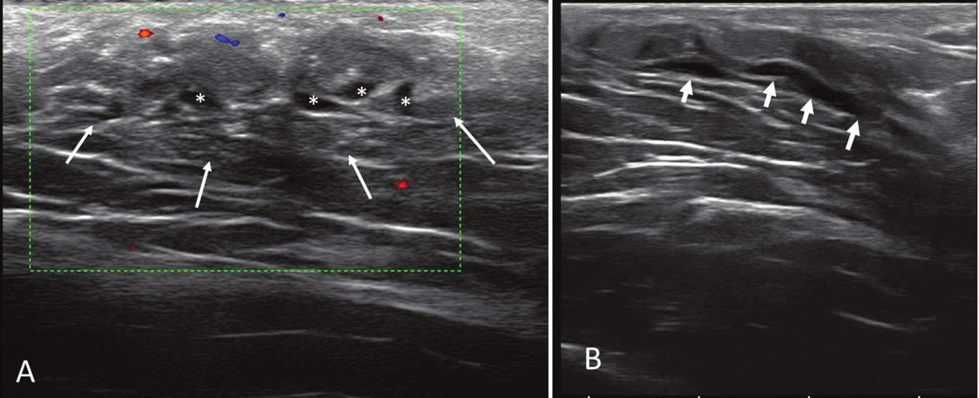 Sonography study. Axial (A) and longitudinal (B) sonograms of the lesion. Notice the anechoic tubular structures (*) and the poorly defined margins of
the mass (white arrows).