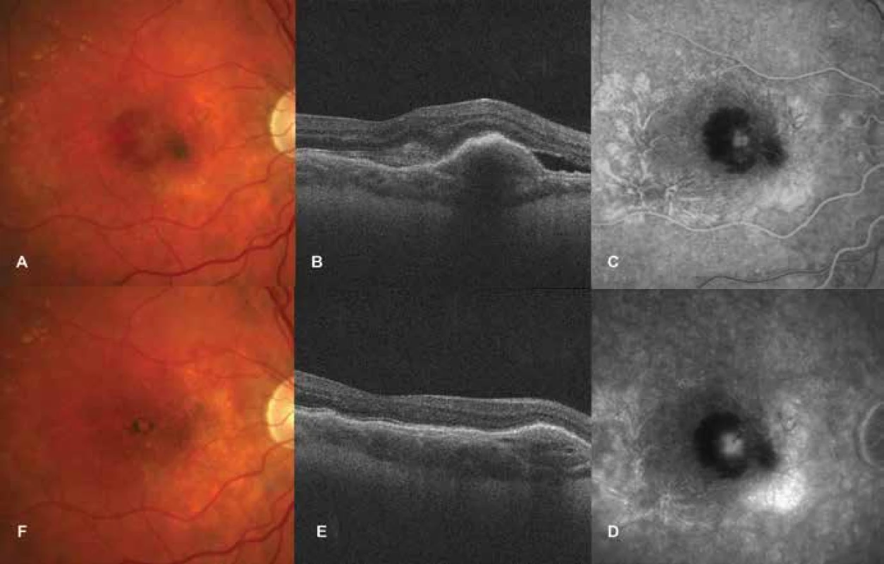 Idiopathic choroidal neovascularisation<br>
A. Photograph of fundus before commencement of treatment with ranibizumab. Lesion on neovascular membrane, subretinal
haemorrhages around lesion<br>
B. HD-OCT before treatment. Ablation and edema of neuroretina, elevation of retinal pigment epithelium.<br>
C-D. FAG finding at first visit. Progressively grading hyperfluorescence of neovascular membrane, blockade of fluorescence
due to subretinal haemorrhage<br>
E. HD-OCT after treatment. Reduction of edema of neuroretina and retinal pigment epithelium<br>
F. Photograph of fundus after treatment. Bordered lesion with pigment