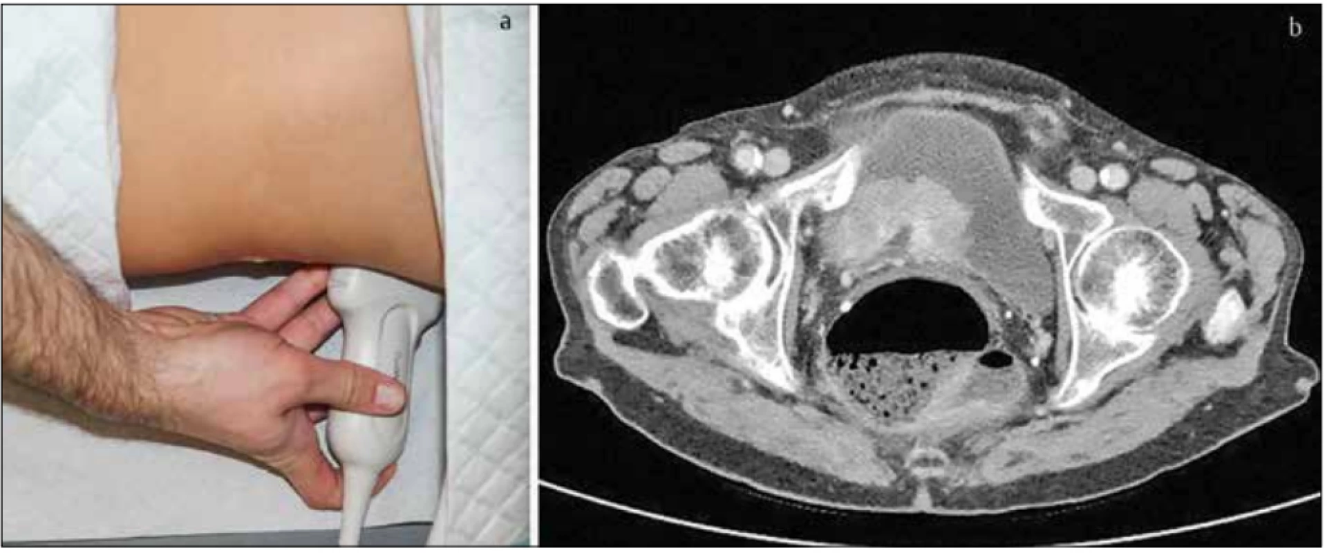 Zobrazovací metody k objasnění hematurie. A – sonografie ledvin, B – CT vyšetření karcinomu močového měchýře. [Zdroje: Prof. Dr. Schulte-Altedorneburg,
Dr. Waidelich (München Klinik Harlaching)]