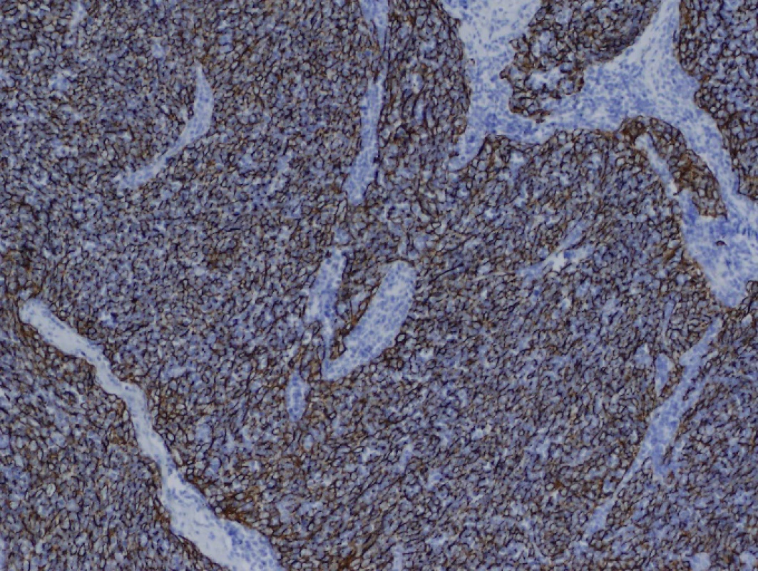 Imunohistochemické vyšetření AE1/3, zvětšení 100krát