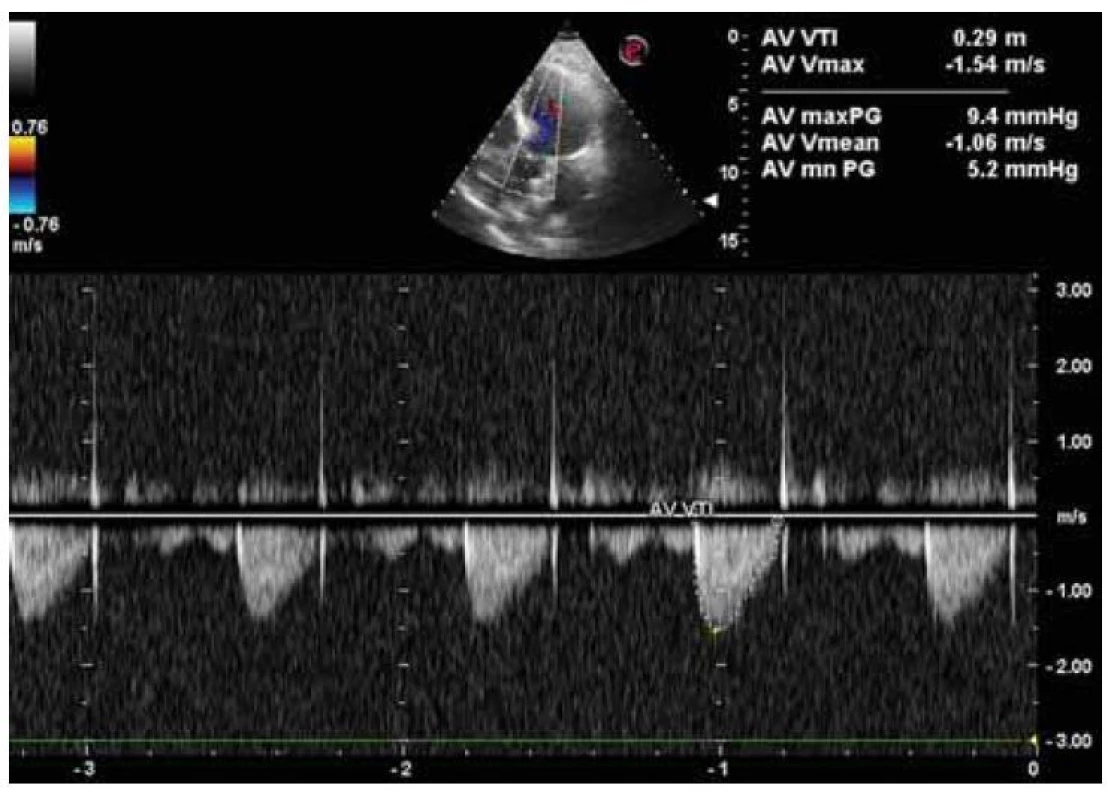 Echokardiografický nález aortálnej stenózy ľahkého stupňa (AVA
1,7 cm2) na podklade sklerodegeneratívnych zmien.<br>
Fig. 5. Echocardiographic finding of mild aortic stenosis (AVA 1,7 cm2) on the basis
of sclerodegenerative changes.