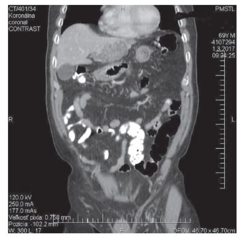 4: CT − sagitálny<br>
Fig. 4: CT. – sagital