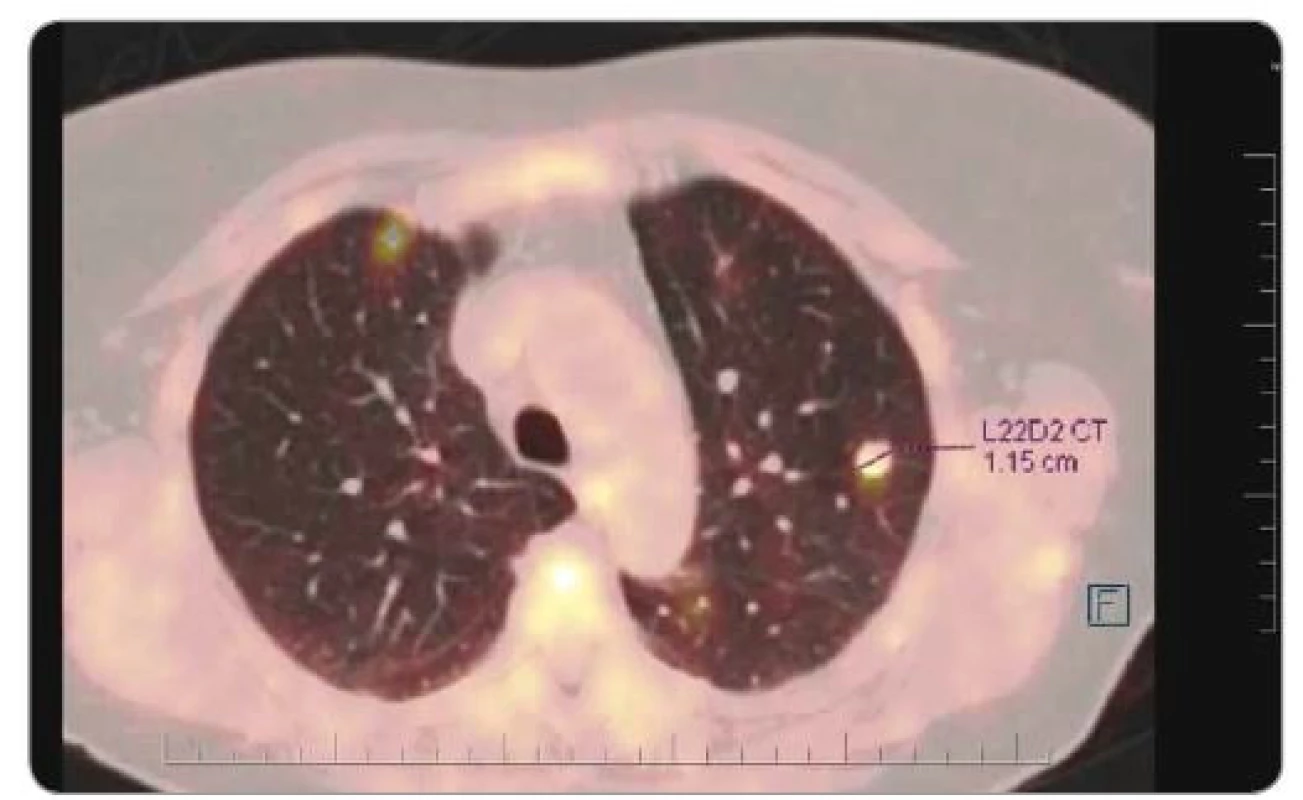 PET/CT v 8/2018 po ukončení léčby Lonsurfem® pro progresi početně stacionárních
plicních metastáz.