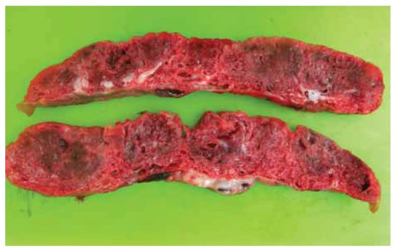 Placenta na řezu, nápadně skvrnitá, s četnými tuhými septy, tkáň je
velmi tuhá i difuzně, tento pohmatový vjem je v rámci makroskopického nálezu
často nápadný.<br>
Fig. 2. Placenta on the incision, strikingly speckled, with numerous rigid septa. The
tissue seems to be very stiff and diffuse. This palpation sensation is often noticeable
within the macroscopic findings.