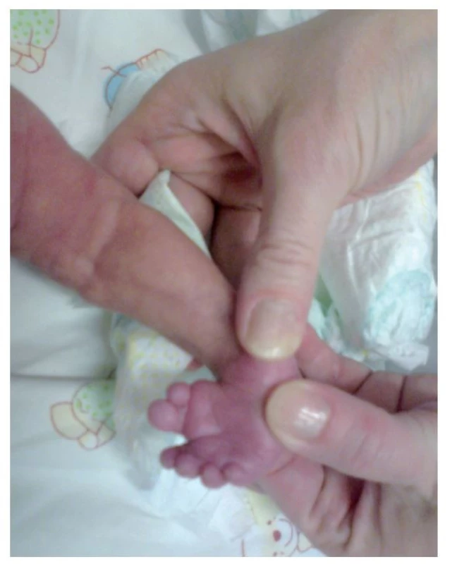 Vrodená vývojová chyba pravého chodidla – talipes equinovarus
s preaxiálnou polydaktýliou.