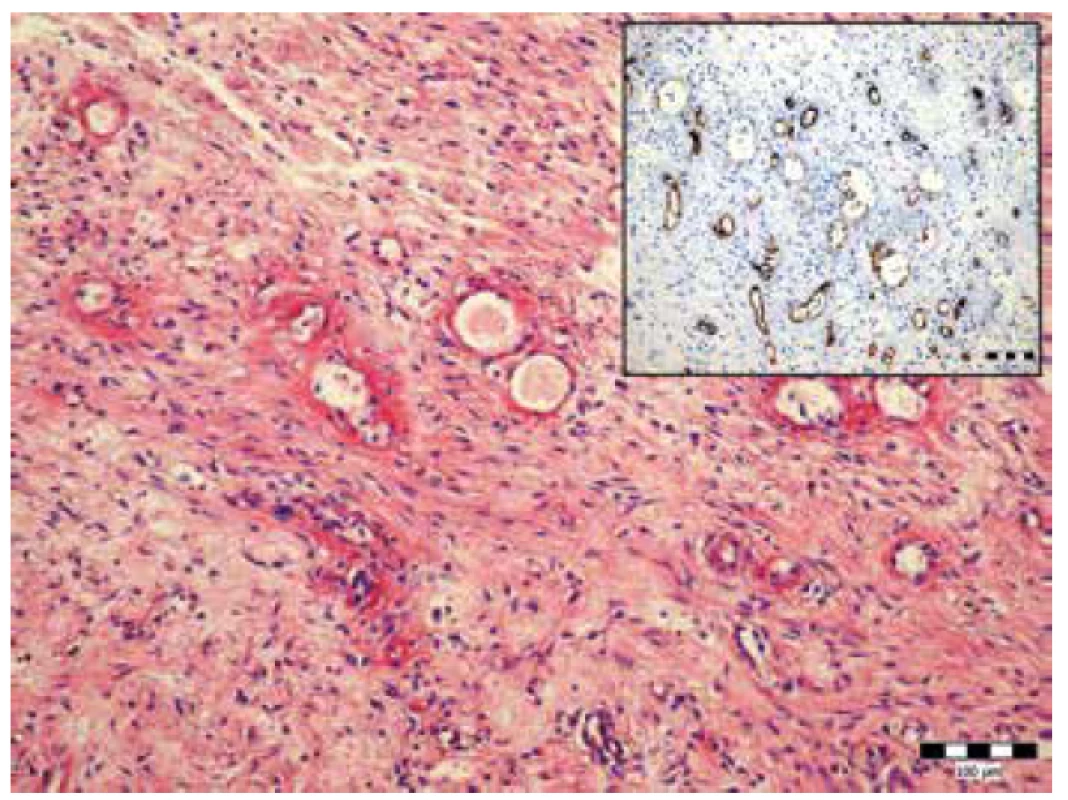 Fibrinoidná nekróza stien ciev malého kalibru v mezentériu. Farbenie
hematoxylín-eozín (zväčšenie 200x). Vložený obrázok imunohistochémia
anti CD-34 (zväčšenie 200x).