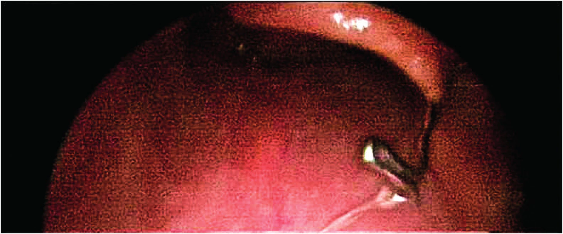  Část rovnátek ve vchodu do jícnu.<br><b> Fig. 11.</b>  Part of dental braces in the entrance to the esophagus,