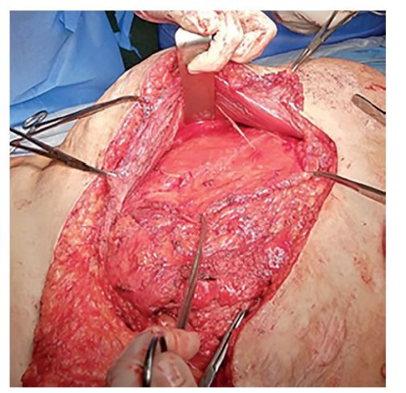 Uvolněná pochva MRA<br>
Fig. 5: Released MRA sheath