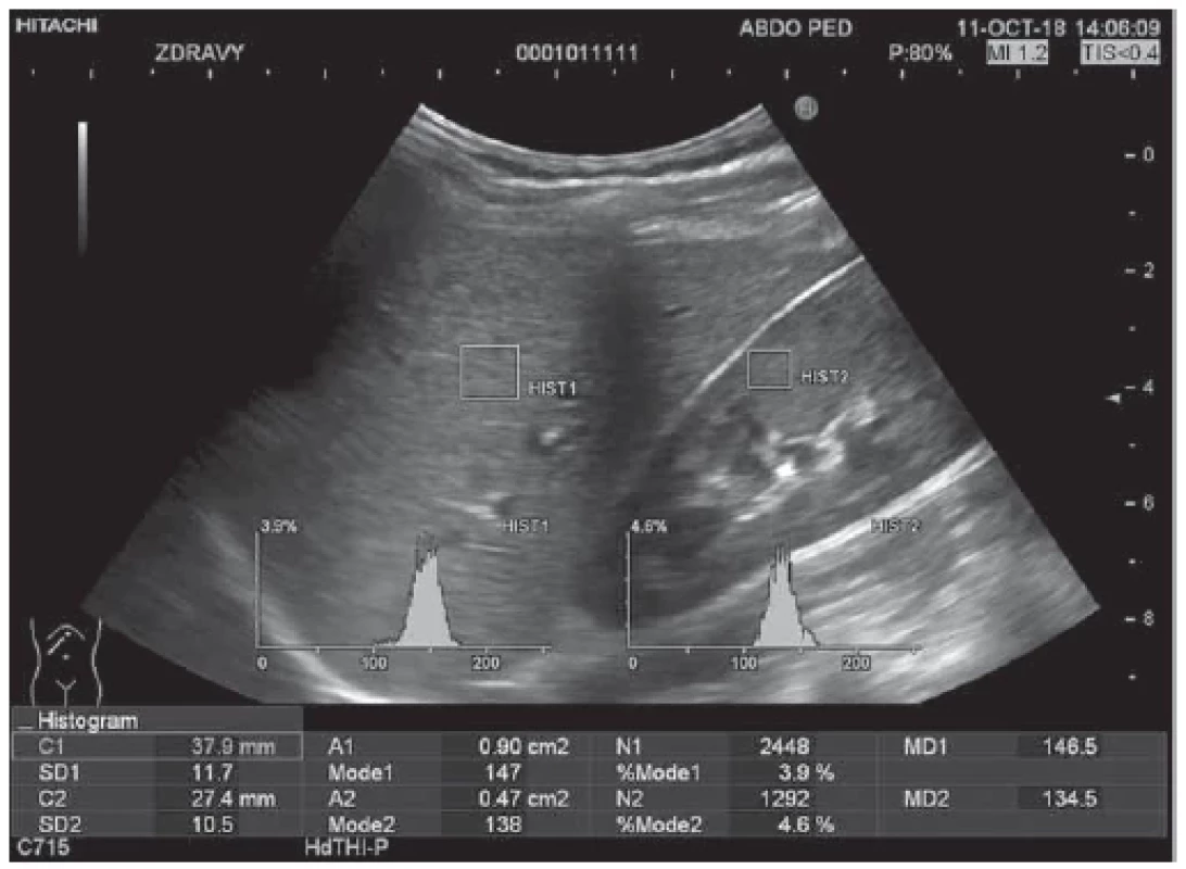 Ultrasound evaluation of liver steatosis – healthy non-obese paediatric patient;
HRI = 1.09.
Obr. . Ultrazvukové vyšetrenie steatózy pečene – zdravý neobézny detský pacient;
HRI = 1,09.