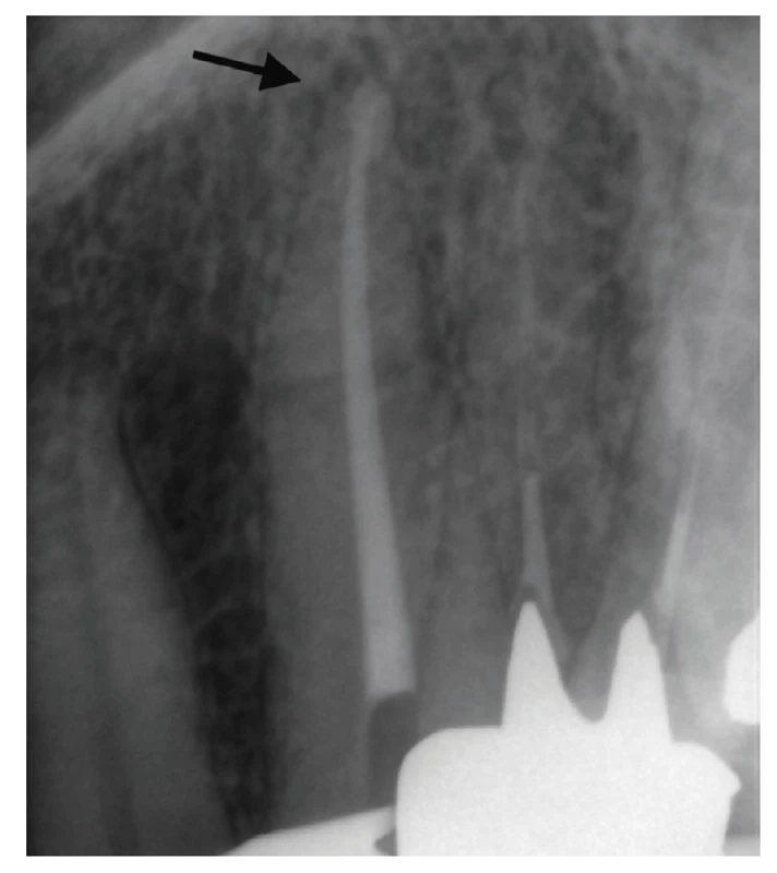 Kontrolní RTG snímek po plnění <br>
Fig. 10 Control X-ray after root canal filling