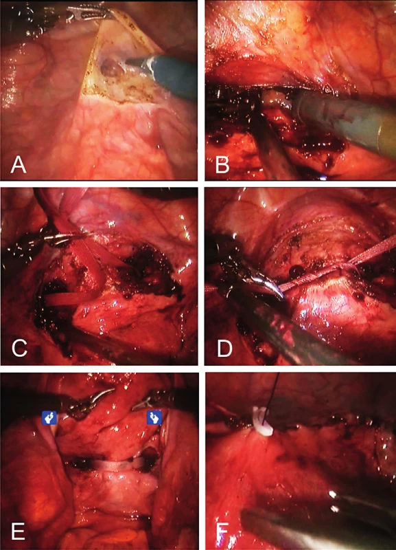 Robotic-assisted abdominal cerclage; (A) preparation
of the vesicouterine excavation, (B) dissection of the avascular
window, (C) passing of the suture, (D) tying of the mersilene tape,
(E) posterior aspect of the tape, (F) placement of a hemolock clip.
