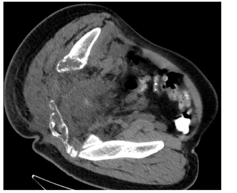 CT scan (axiální rovina) – patologická masa v pánvi, zejména
vpravo s osteolytickými změnami skeletu