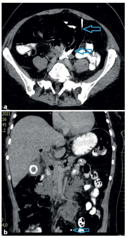 (a−b) CT – drén vycestovaný z dc. choledochus do
tenkého střeva (modrá šipka)<br>
Fig. 4 (a−b) CT scan – the drain, moved from the common
bile duct into the small bowel (blue arrow)