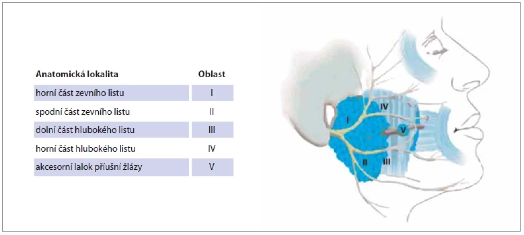 Klasifi kační systém parotidektomií upraven podle Quer et al. [15]. <br> 
Fig. 1. Classifi cation of parotidectomies according by Quer et al. [15].