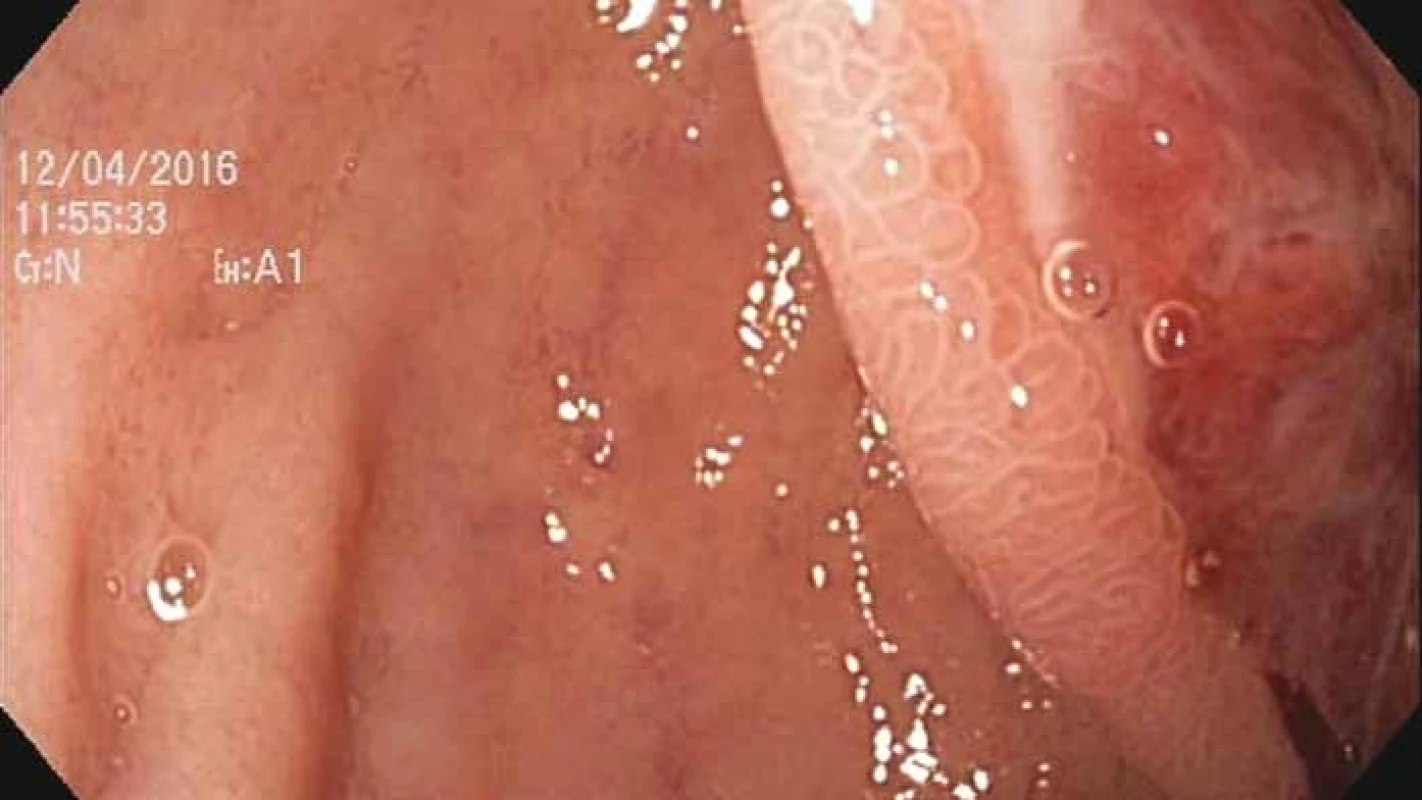 Endoskopický nález ulcerácie na rozhraní apexu bulbu duodena a D2
v normálnom svetle.<br>
Fig. 5. Endoscopic finding of ulceration at the apex of the duodenal bulb and D2
in normal light.