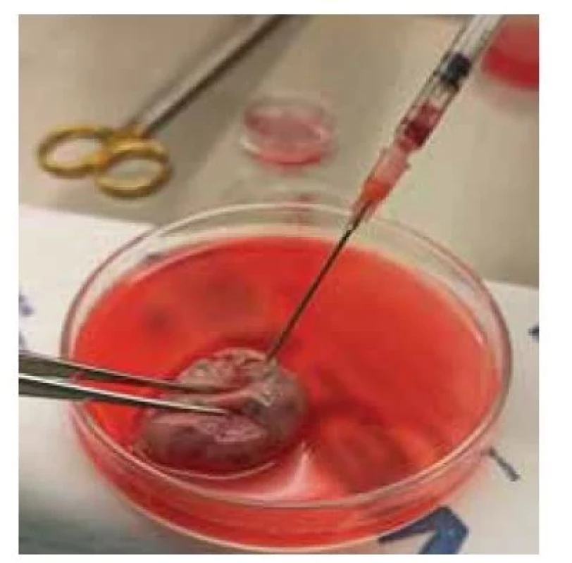 Aspirace oocytů z antrálních
folikulů z povrchu ovaria.<br>
Fig. 1. Aspiration of oocytes from antral
follicles from the ovarian surface.