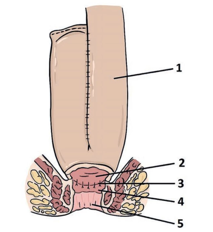 Topografie ileálního pouche.<br>
1) aferentní klička tenkého střeva; 2) apex ileálního pouche; 3) ileo-rektální
anatomóza; 4) Rektální manžeta (zbytek původního rekta); 5) anus.