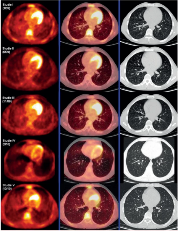 Korelace PET-CT plic, HRCT plic a indexu SUV Pulmomax/SUV Heparmax před léčbou, po
4 cyklech léčby 2-chlordeoxyadenosinem, dále v době relapsu nemoci a po dvou cyklech léčby relapsu
režimem CHOEP (cyklofosfamid, etoposid, adriamyin, vinkristin a prednison). Uvedený index koreloval
s aktivitou nemoci.